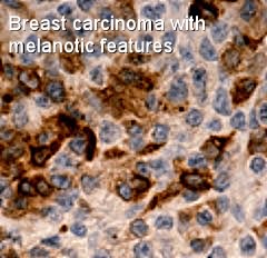 breast carcinoma stained for melanocytes