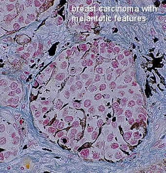 breast cancer with melanotic features
