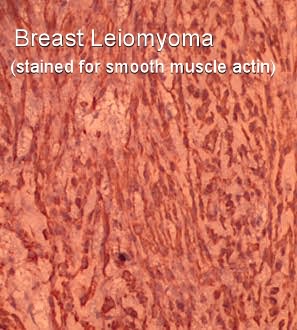 does tamoxifen cause muscle pain