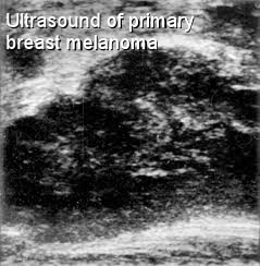 ultrasound of melanoma within the breast