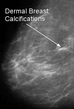 breast calcification clusters