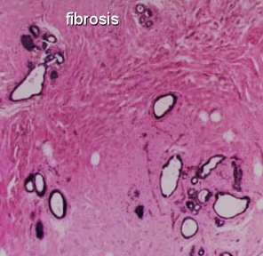Image result for pictures of radiation fibrosis
