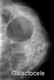breast galactocele 