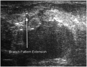 branch pattern extension o f tumor
