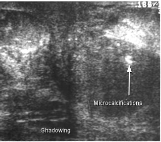 retroareoloar infiltration, shadowing, microcalcifications