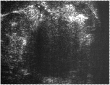 curvilinear extension of tumor, spliculation, global extension