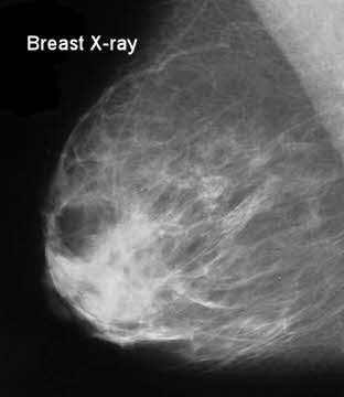mammogram benign abnormal benigni thankfully