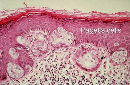 Paget cell | definition of Paget cell by Medical dictionary