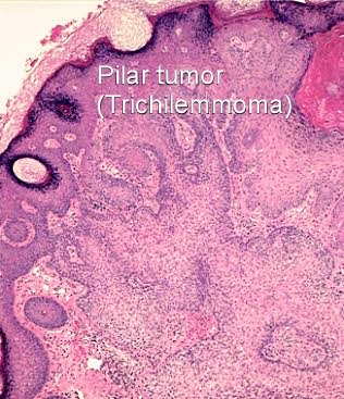 pilar cyst cancer