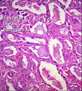 Secretory Carcinoma Breast