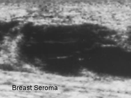What causes a seroma after back surgery?
