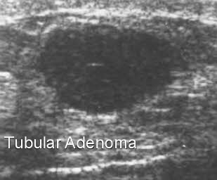 Tubular Adenoma Breast