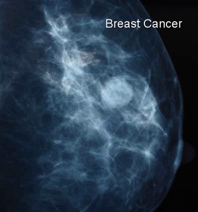 X-ray breast cancer