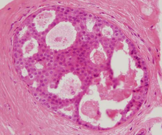Fig-4-1 Atypical Ductal Hyperplasia