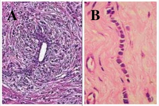 invasive lobular breast cancer