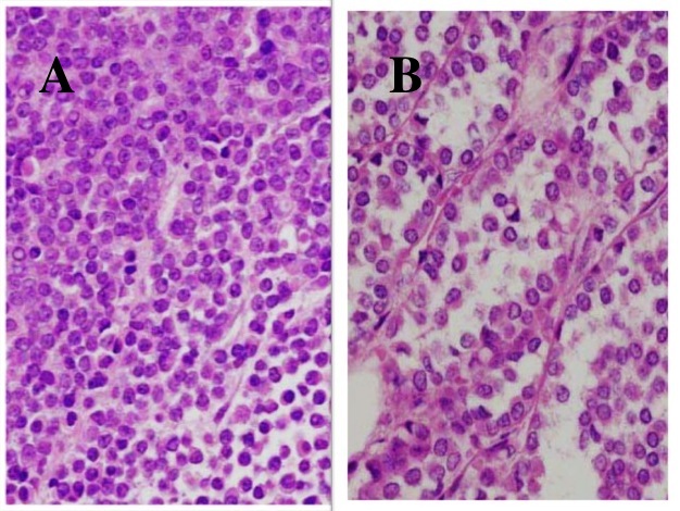 Fig 5-13 invasive lobular breast cancer