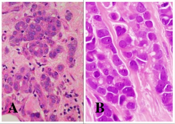Fig 5-15 Tubulolobular carcinoma