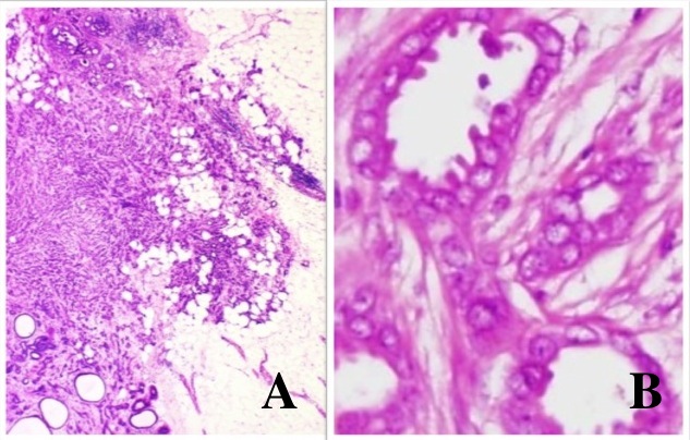Fig 5-16 Tubular carcinoma low and high power