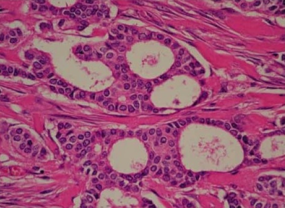 Fig 5-17 Invasive cribriform carcinoma