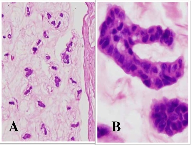 Fig 5-18 Mucinous Carcinoma