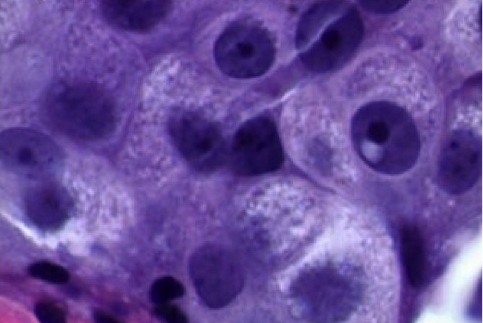 Fig 5-20 Apocrine carcinoma