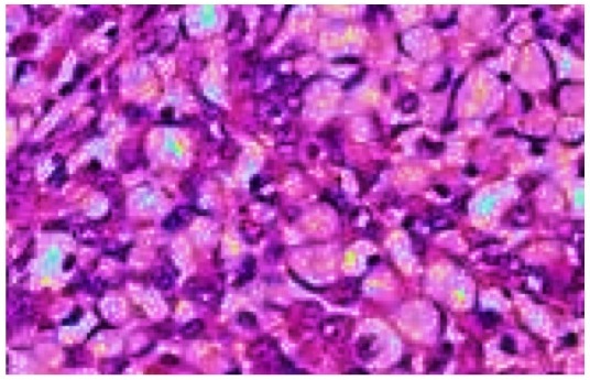 Fig 5-21 Signet ring cell change