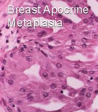 intraductal papilloma with focal apocrine metaplasia