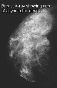 Breast asymmetry: Causes, diagnosis, and mammogram results