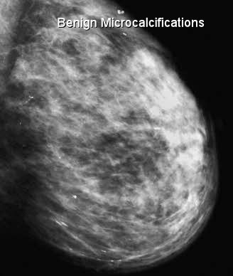 breast calcification clusters