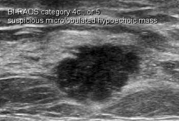 Showing marked breast asymmetry with a huge right breast mass and