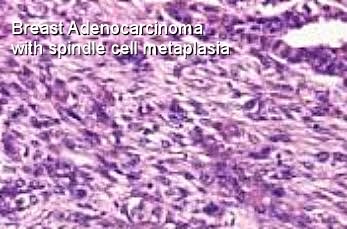 sarcomatoid carcinoma of the breast Minka porn video clips