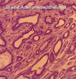 breast-adenomyoepithelioma-cells-2