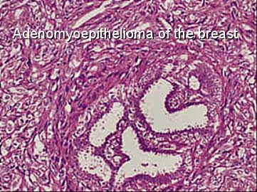 breast-adenomyoepithelioma-cells