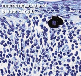 Micrometastases to lymph nodes - Moose and Doc