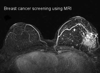 Factors surrounding breast MRI screening and treatment