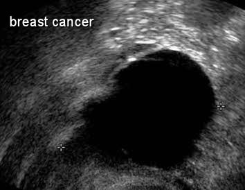 Breast Cancer Stages  Explained by Moose and Doc