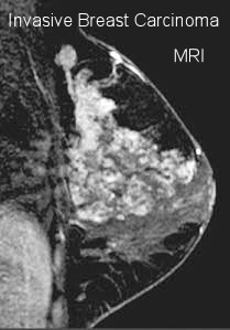 Findings of the right nipple; ultrasound and MR images of the breast. a