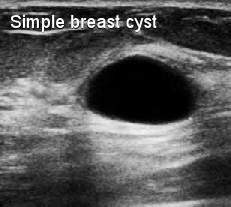 What is a Breast cyst?  Moose and Doc