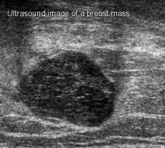 Ultrasound for Breast Cancer Screening - Moose and Doc