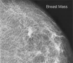 A) Anterior view of huge ulcerated mass at right breast with 32 weeks