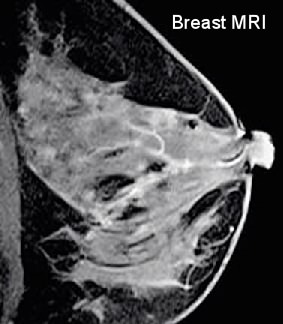 breast mri follow up Long heavy cock
