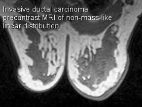 T Mri Nonm Linear Precontrast Invasive Ductal Carcinoma T Mri Nonm Linear Precontrast Invasive Ductal Carcinoma
