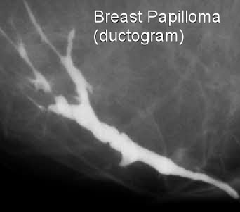 intraductalis papilloma ductogram)