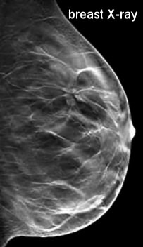 Radiologist role in breast cancer diagnosis - Moose and Doc