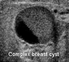 A Complex Cyst of the Breast Moose and Doc