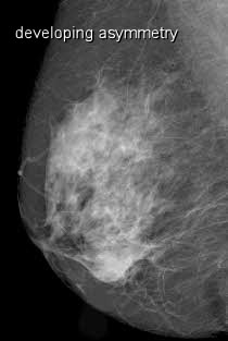 Asymmetric breast development.