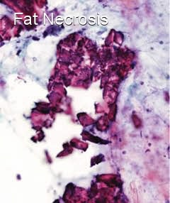 Fat necrosis within a breast - Moose and Doc