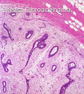 Most Common Breast Masses - Comparison between Fibroadenoma