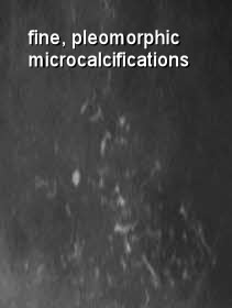 breast pleomorphic fine microcalcifications
