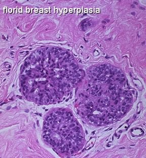intraductal papilloma with florid ductal hyperplasia)